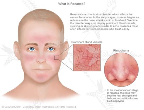 Skin redness, bumps that look like acne, and an enlarged nose are some common rosacea symptoms. Was ist Rosacea? Symptome, Ursachen und Behandlungen ...