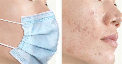 In some cases, acne in a specific area of the face can be linked to a deeper issue. Is Wearing a Face Mask Causing Breakouts? | Mercy Health Blog