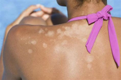 Remove Pesky White Sunspots With These 8 Simple Home Remedies