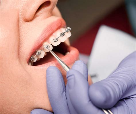 Brackets Y Ortodoncia Invisible Centro Odontológico Londres