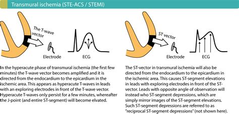 The ecg changes in this phase are 1.tall,symmetrical,peaked and widened t waves 2.slope elevation of st segment 3.increased amplitude of r wave/changes in. ECG in myocardial ischemia: ischemic changes in the ST ...