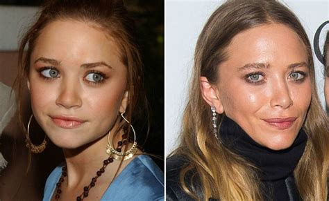 Mary Kate Olsen Plastic Surgery Before And After Photos
