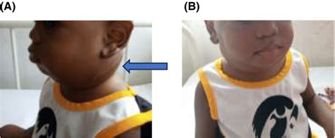A And B Bilateral Neck Swelling Download Scientific Diagram