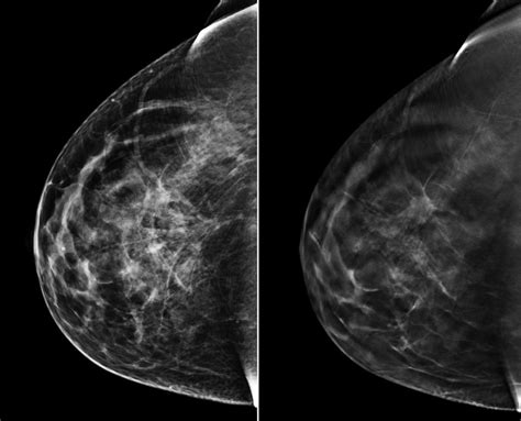 Breast Cancer Breakthrough 3d Mammograms Offer Sharper Results