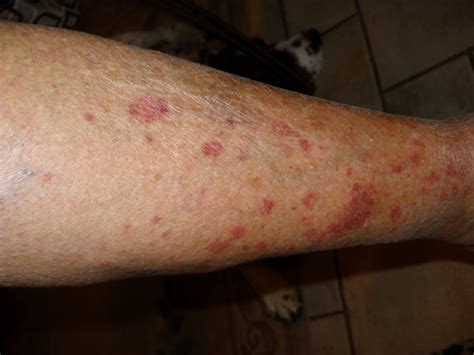 Small Red Dots On Leg Pictures Photos