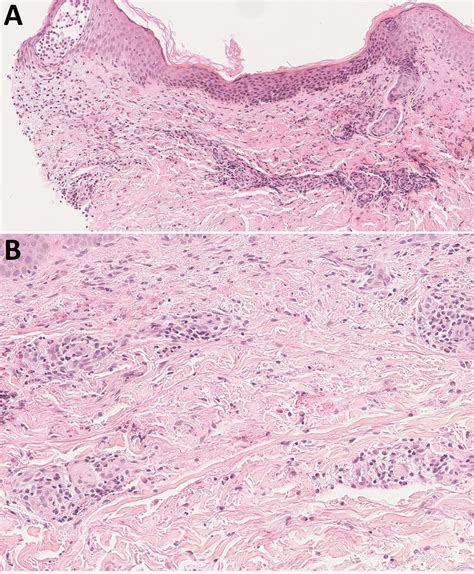 Figure 2 Recurrent Cellulitis Revealing Helicobacter Cinaedi In