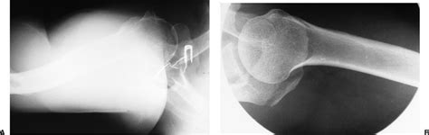 Scapula Fractures | Musculoskeletal Key