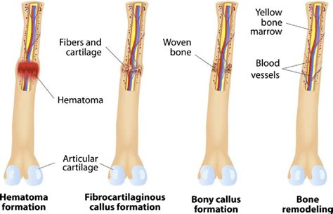 Stages Of Bone Fracture Repair And Remodeling Download Scientific Diagram