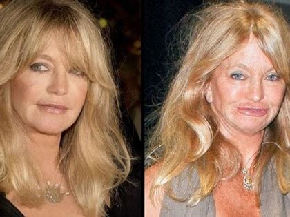 Top Botched Plastic Surgery Fails Before And After Photos In