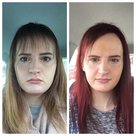 Day 3 Vs Day 110 On Hrt T Blocker Injection And Estrogen Patches How