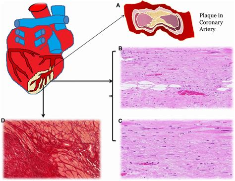 Pathogenesis Of Cardiac Fibrosis Ischemic Injury To The Heart Is
