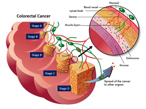 Colorectal Cancer System Disorder Template
