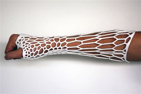 3d Printed Cortex Cast Concept Puts A Modern Spin On Bone Fracture Treatment The Verge
