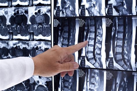 What You Need To Know About Spinal Cord Injuries Brickley Law