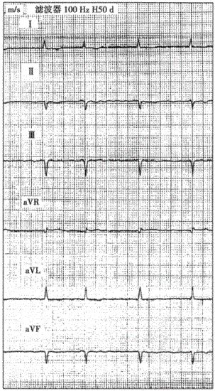 患者男性，40岁，扩张型心肌病。心电图如下图所示，与该心电图表现不符合的诊断是 ... - 千题库