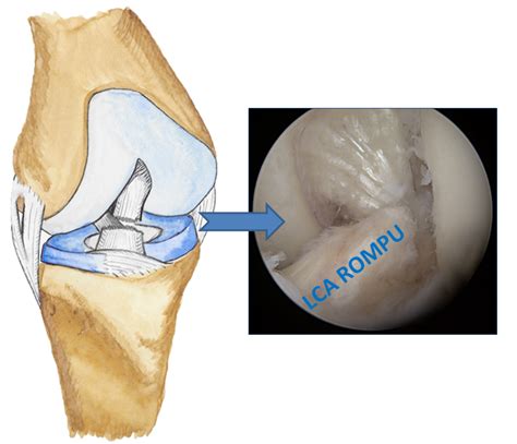 Rupture du ligament croisé antérieur Réunion 974 ligamentoplastie DT4