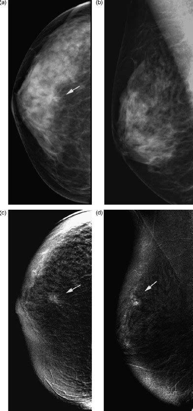 Contrast Enhanced Digital Mammography European Journal Of Radiology