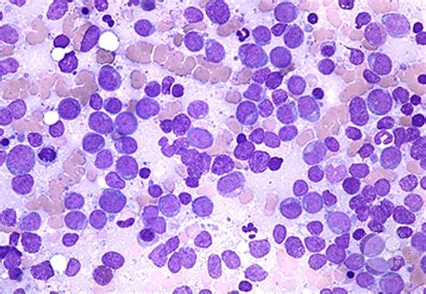 Acute Myeloid Leukemia Without Maturation 1