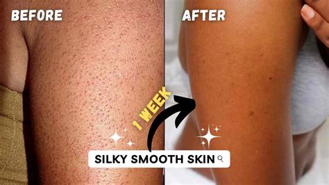 How To Get Rid Of Texture Skin Body Acne Bumps Keratosis Pilaris