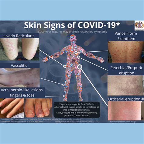 Purpura Rash Causes The Cutaneous Manifestations Of Henoch Schonlein