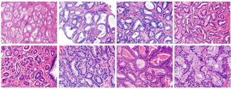 Prostate Cancer Grading System Urologic Pathology Division Johns