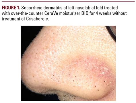 Chronic Nasolabial Fold Seborrheic Dermatitis Successfully Controlled