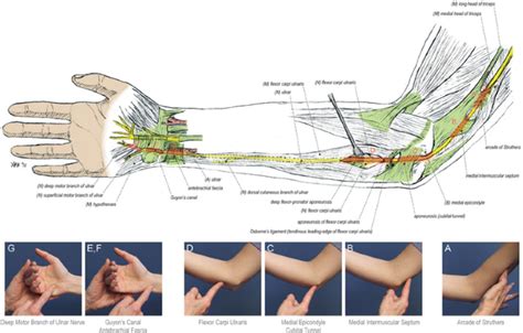 Professional Ulnar Nerve Transposition Surgery Sforzo Dillingham