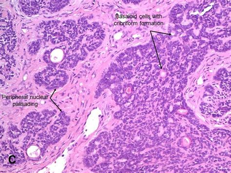 American Urological Association Basal Cell Carcinoma Adenoid Cystic