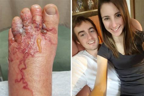 Couple Catch Skin Disease After Making This Common