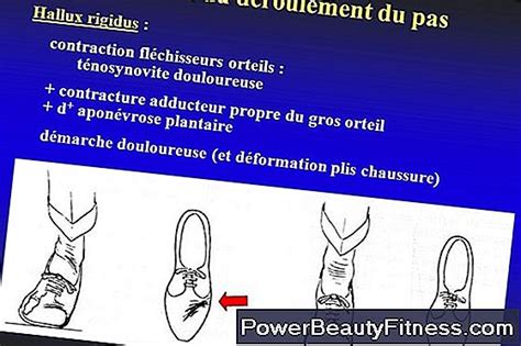 Les articulations douloureuses doivent être ménagées. Articulation Douloureuse Du Gros Orteil En Exécutant ...