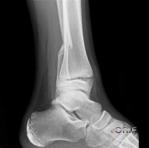 Pediatric Distal Tibial Physeal Fractures S82.209A 823.80 ...