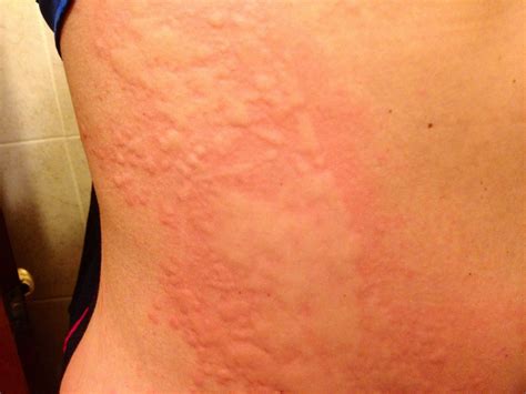 Severe Case Of Hives Health And Fitness Pinterest Urticaria