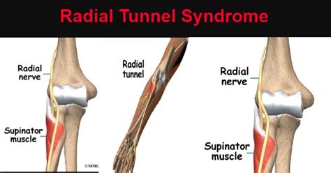Radial Tunnel Syndrome Causes Symptoms And Treatments Body Pain Tips