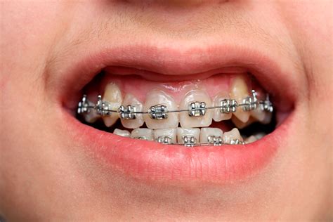 Orthodontic Bands Advantages And Disadvantages Orthodontics Metal