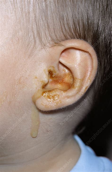 Otitis Media Infection Stock Image M1570058 Science Photo Library