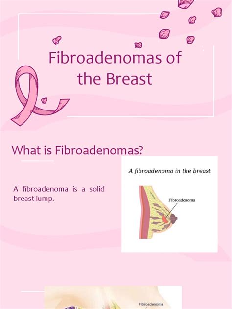 An Overview Of Fibroadenomas Common Benign Breast Lumps Causes Risk