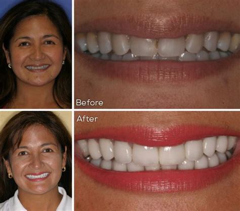 3 how much does teeth whitening cost? Teeth Whitening in Destin, Panama City Beach & Navarre FL