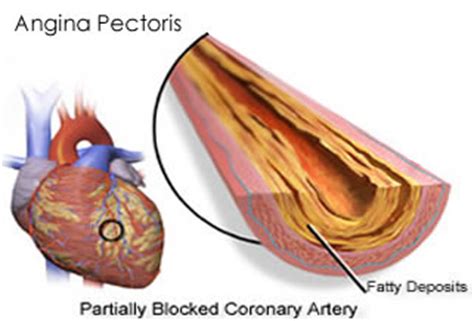 Angina Pectoris Treatment | Cure Pages