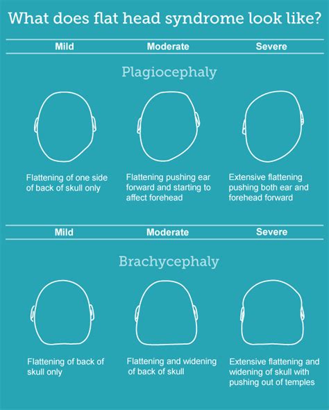 Plagiocephaly And Brachycephaly Flat Head Syndrome Babycentre
