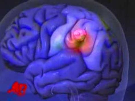 What you need to know. Ted Kennedy Has Brain Tumor - YouTube