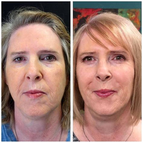 Thermage For Neck Before And After 4 Thermage Facelift Photo