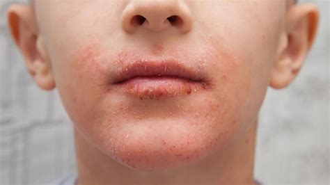 Best Way To Get Rid Eczema On Lips