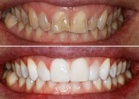 Porcelain Dental Veneers In Cheam Sutton Surrey Love Teeth Dental