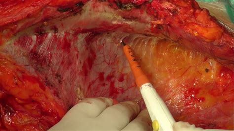 Clinically mesothelioma of a peritoneum is shown by abdominal pains. CRS and HIPEC for peritoneal mesothelioma - YouTube