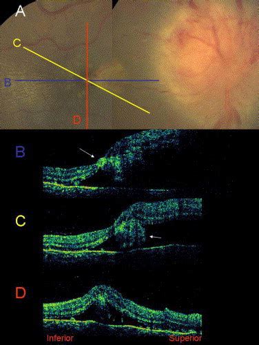 Macular Hole In Cat Scratch Disease American Journal Of Ophthalmology