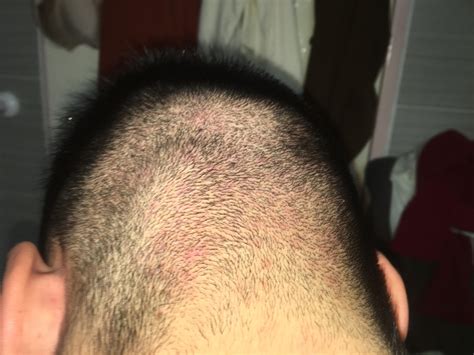 Skin Concerns Help Red Marks After Years Of Severe Hair Folliculitis