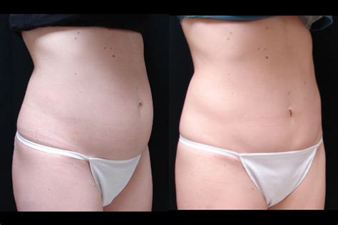 Abdominoplasty For Muscle Tightening Associates In Plastic Surgery