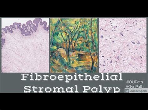 Fibroepithelial Stromal Polyp Of Vagina Youtube