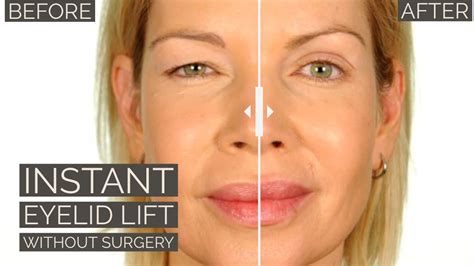 Instant Eyelid Lift Without Surgery Youtube