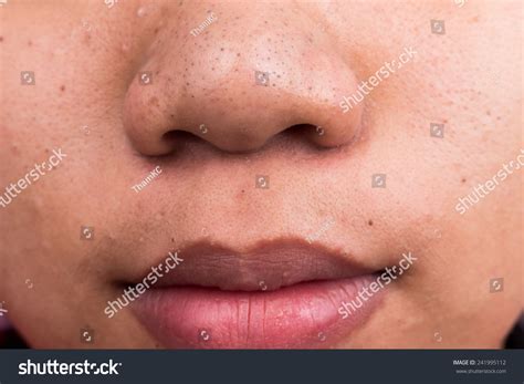 Pimple Blackheads On The Nose And Mouth Area Of An Asian Teenager Stock